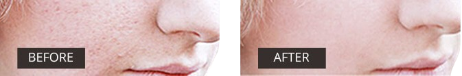 Side-by-side comparison showing the results of scar reduction with Dermefface FX7