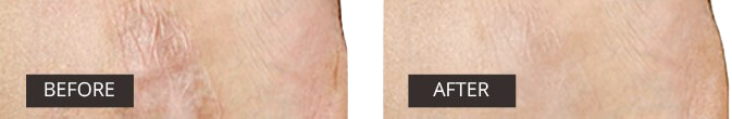 Side-by-side comparison showing the results of scar reduction with Dermefface FX7