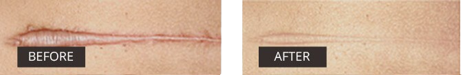 Side-by-side comparison showing the results of scar reduction with Dermefface FX7